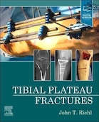 Tibial Plateau Fractures | شکستگی های فلات تیبیا